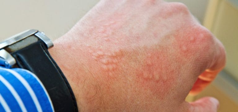Dermatita de contact