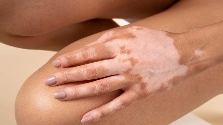 Vitiligo